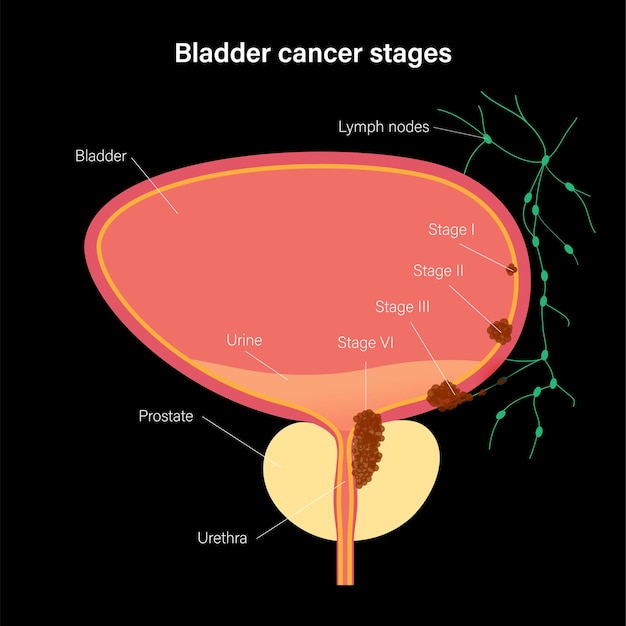 Estágios do câncer de bexiga