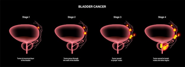 Estágios do câncer de bexiga