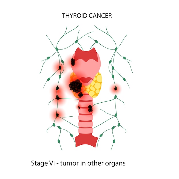 Estágios do câncer de tireoide