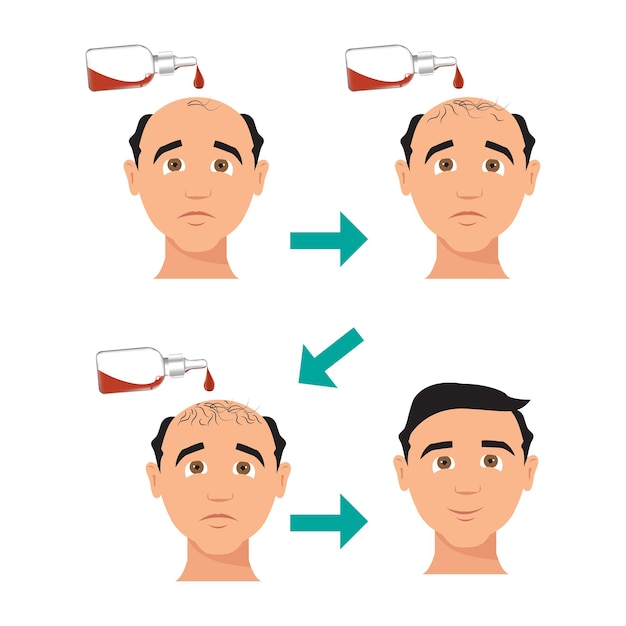 Estágios do tratamento e transplante masculino para queda de cabelo ilustração vetorial