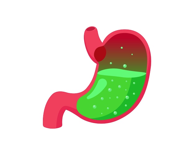 Vetor estômago gerd ou envenenamento com ácido líquido verde dentro da doença da barriga do refluxo gastroesofágico