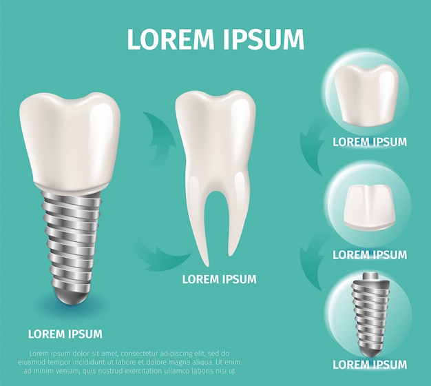 Estrutura de imagem realista do implante dentário