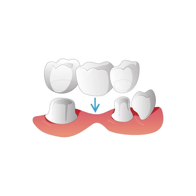 Estrutura de implante dentário 3