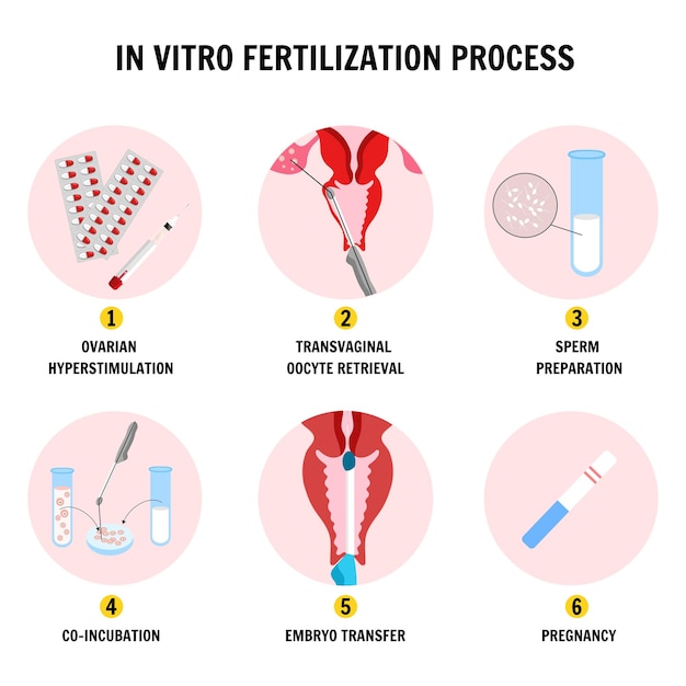Vetor etapas da composição da fertilização in vitro em vetor