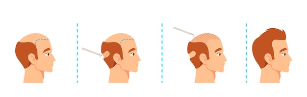 Etapas do procedimento de transplante capilar Couro cabeludo masculino antes e depois Auxílios visuais para materiais médicos ou educacionais