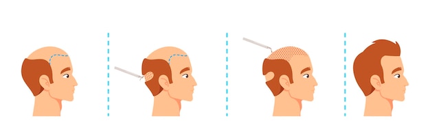 Vetor etapas do procedimento de transplante capilar couro cabeludo masculino antes e depois auxílios visuais para materiais médicos ou educacionais