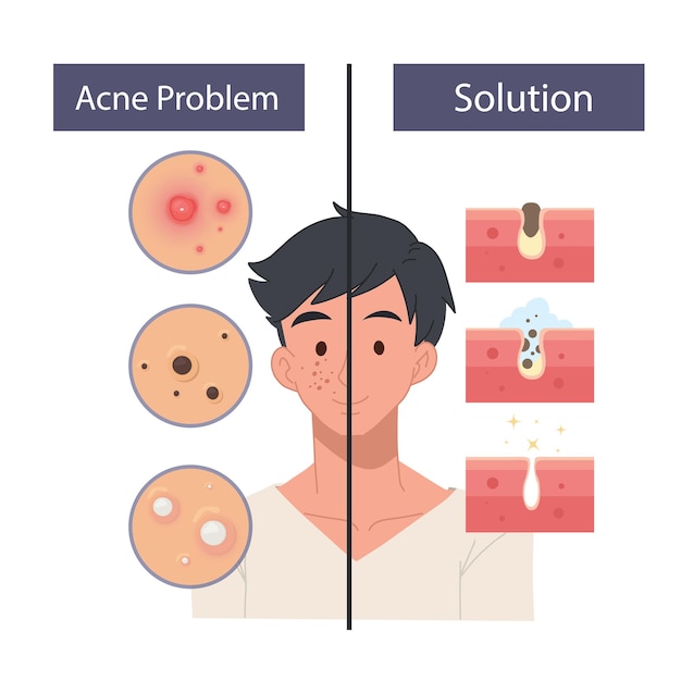 Face Care Men concept Defeitos de pele de cuidados faciais problemas de pele acne tratamentos faciais Ícones de cuidados faciais