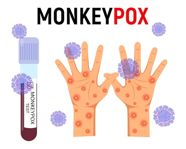Fundo de varíola de macaco um tubo de ensaio com sangue para um teste e uma mão humana com erupção cutânea e úlceras