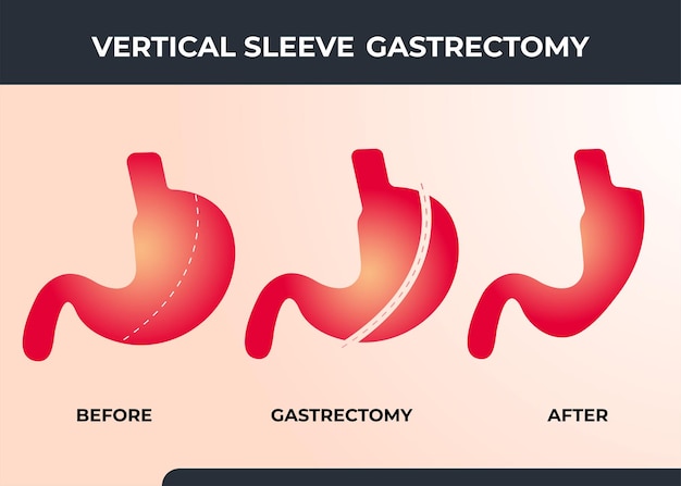 Gastrectomia vertical laparoscópica gastrectomia vertical cirurgia para perda de peso ilustração vetorial