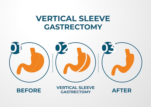 Gastrectomia vertical laparoscópica gastrectomia vertical cirurgia para perda de peso ilustração vetorial