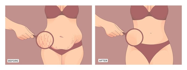 Gordura abdominal. Antes e depois da perda de peso, transformação da forma do corpo da mulher, Fat To Fit.