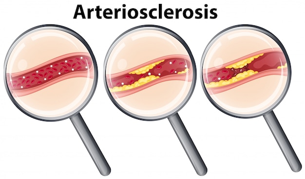 Humano com arteriosclerose ampliada