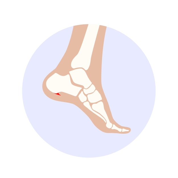 Vetor Ícone de esporão calcaneal diagnóstico e tratamento de problemas do pé em uma clínica de podologia crescimento do osso do calcanheiro a partir da tuberosidade calcaneal dor e inchaço do tornozelo exame de raios-x dos pés ilustração vetorial