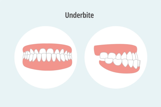 Ícone ilustração vetorial problema dental underbite front and lateral