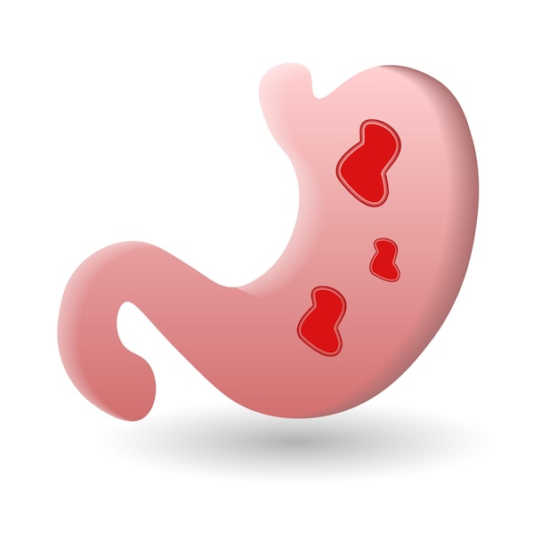 Ilustração 3d do ícone Ilcers da coleção de doenças Ícone 3d criativo do Ilcers para infográficos de modelos de web design e muito mais