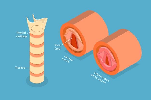 Ilustração conceitual de laringite por vetor plano isométrico 3D
