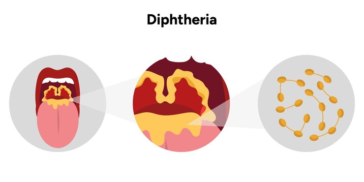 Vetor ilustração de boca aberta de difteria com zoom de garganta e zoom bacteriano