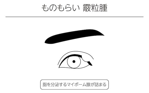 Vetor ilustração de desenho de linha de clipart médica de doença ocular e calázio chiqueiro