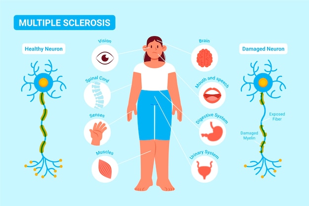 Vetor ilustração de esclerose múltipla de design plano desenhado à mão