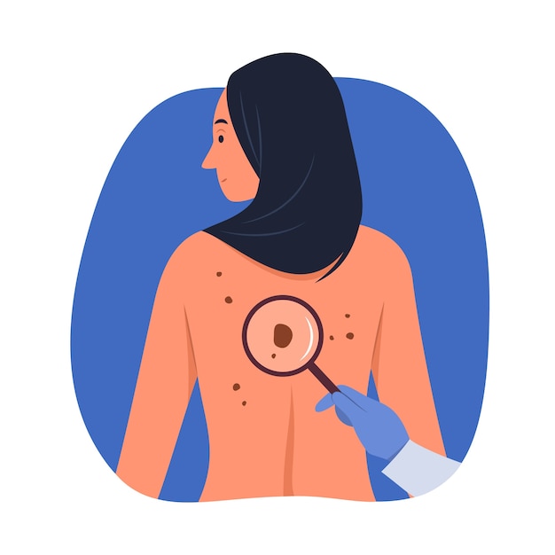 Vetor ilustração de melanoma de design plano desenhado à mão