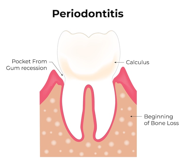 Vetor ilustração de periodontite vetorial pocket from gum recession calculus começo da perda óssea