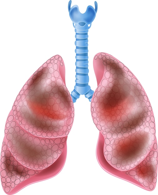 Ilustração de pulmões de fumantes