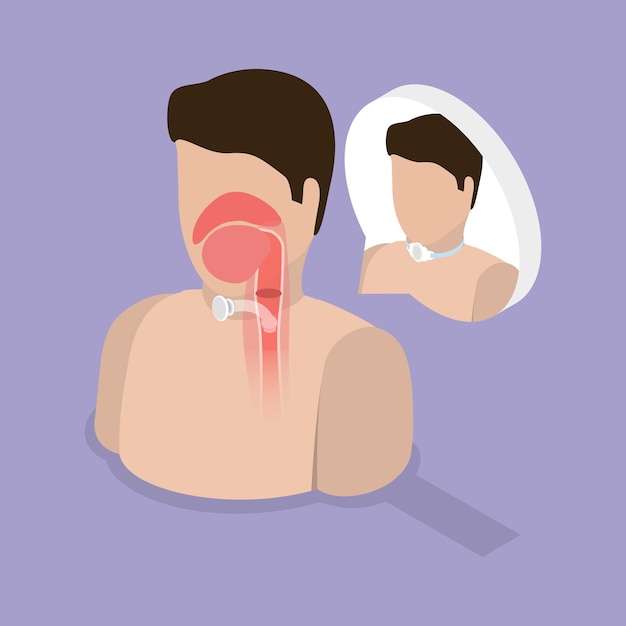 Ilustração de vetor plano isométrico de cirurgia traqueostômica da traqueia