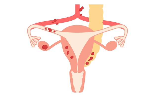 Vetor ilustração diagramática da anatomia do cancro ovárico em estágio iii do útero e dos ovários