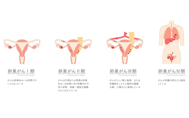 Vetor ilustração diagramática da anatomia do útero e dos ovários no estágio i do cancro do ovário