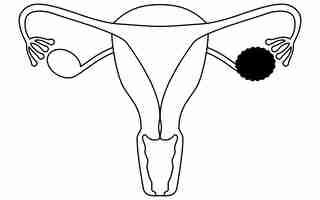 Vetor ilustração diagramática de cistos ováricos anatomia do útero e dos ovários