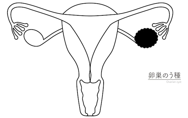 Ilustração diagramática de cistos ováricos anatomia do útero e dos ovários