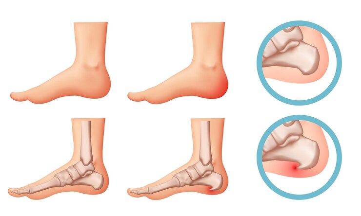 Vetor ilustração do esporão do calcanhar elementos de design sobre o tema da fascite plantar conjunto de vetores