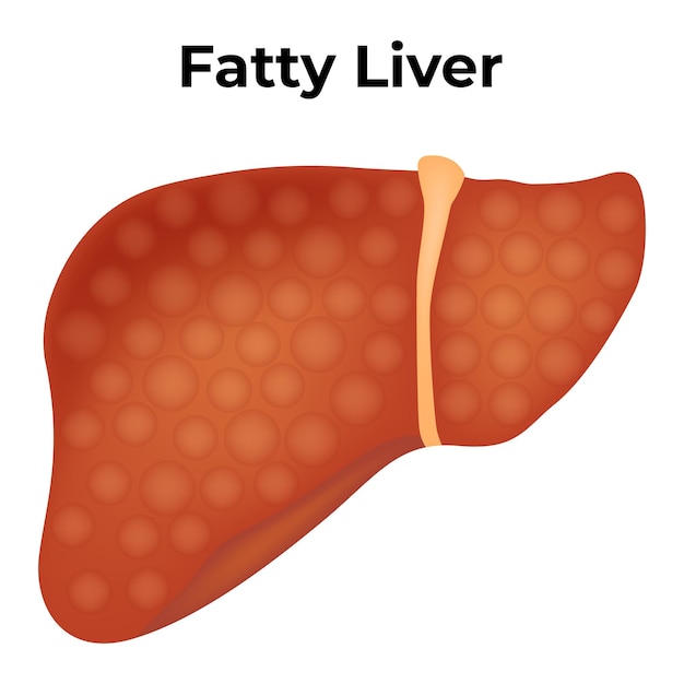 Vetor ilustração do vetor da anatomia do fígado gordo