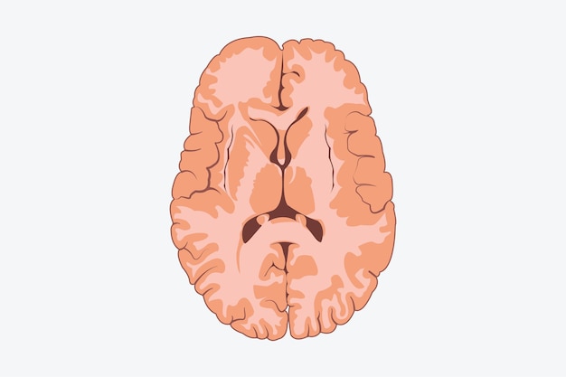 Vetor ilustração do vetor de doença anatômica humana em fundo branco eps 10