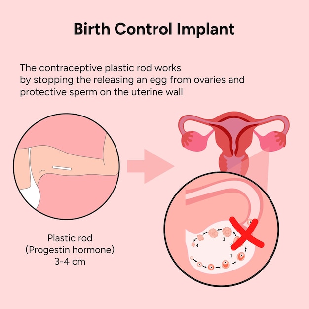 Vetor ilustração e infográfico do implante anticoncepcional em vetor