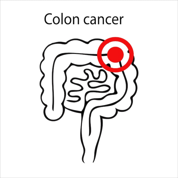 Ilustração em vetor de câncer de cólon Cólon humano desenhado à mão isolado no fundo branco