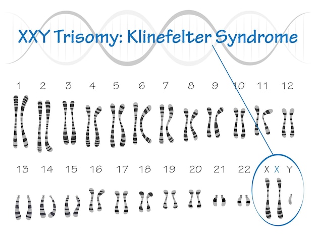 Ilustração em vetor de cariótipo de síndrome de klinefelter