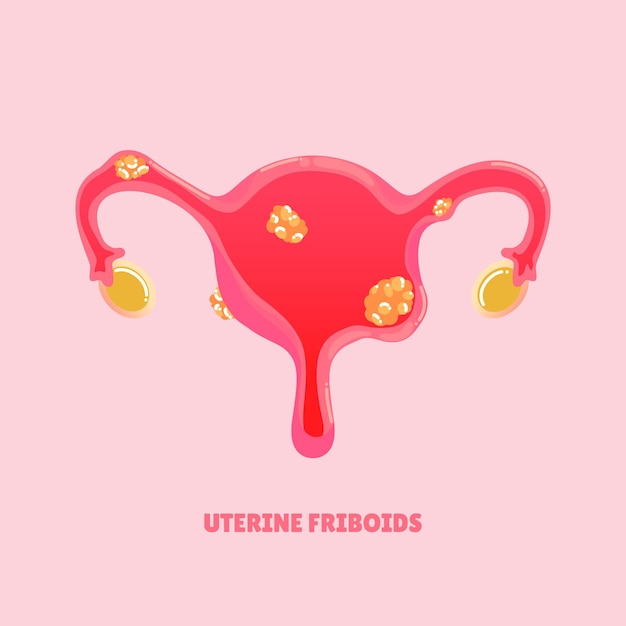 Vetor ilustração em vetor doença miomas uterinos