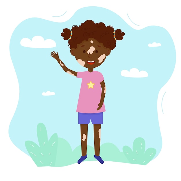 Ilustração em vetor dos desenhos animados de menina feliz com síndrome de vitiligo. ilustração do corpo positivo