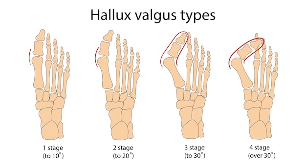 Vetor ilustração em vetor infográfico médico de hálux valgo