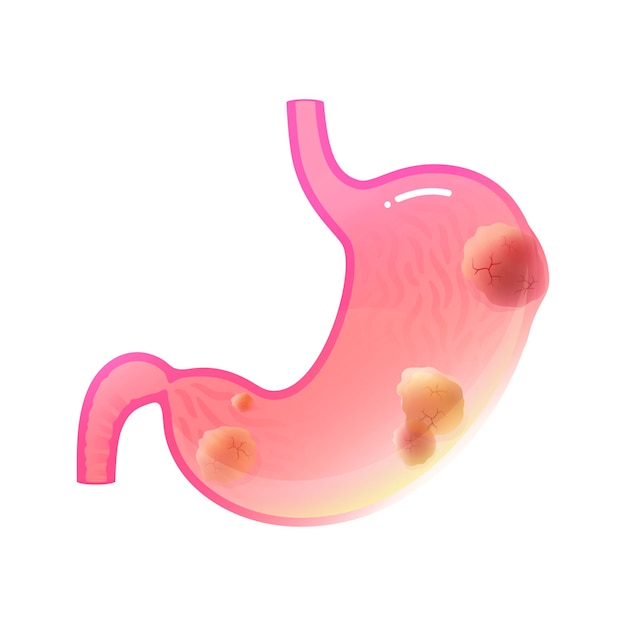 Ilustração em vetor isolada da anatomia do estômago com tumor de câncer. cirurgia do sistema digestivo humano