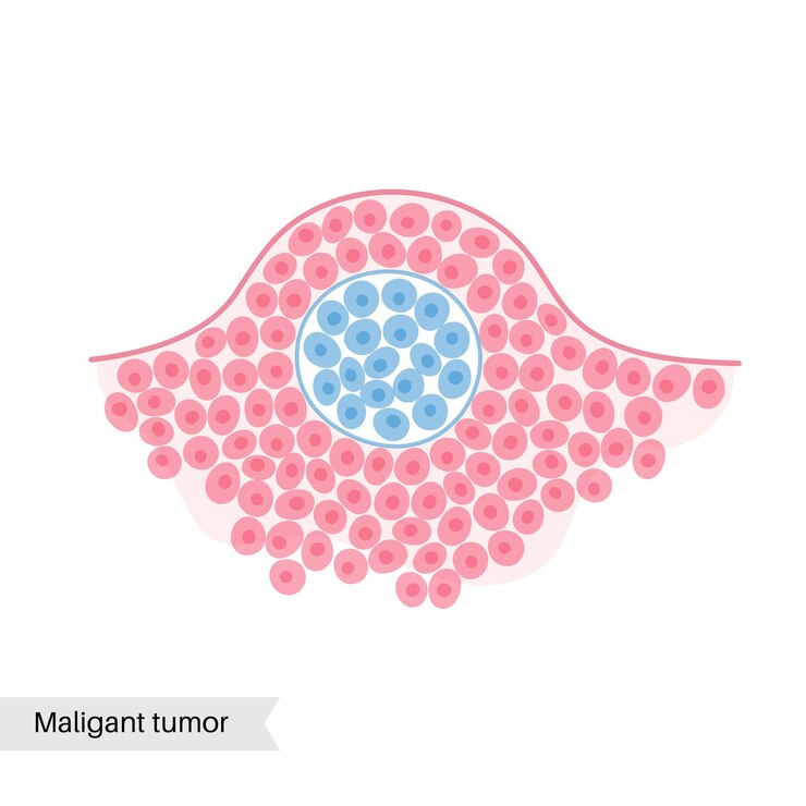 Vetor ilustração em vetor isolada de tumor benigno no tecido. diagrama médico para uso em cartaz, educacional, científico e médico. ícone ou logotipo biológico.