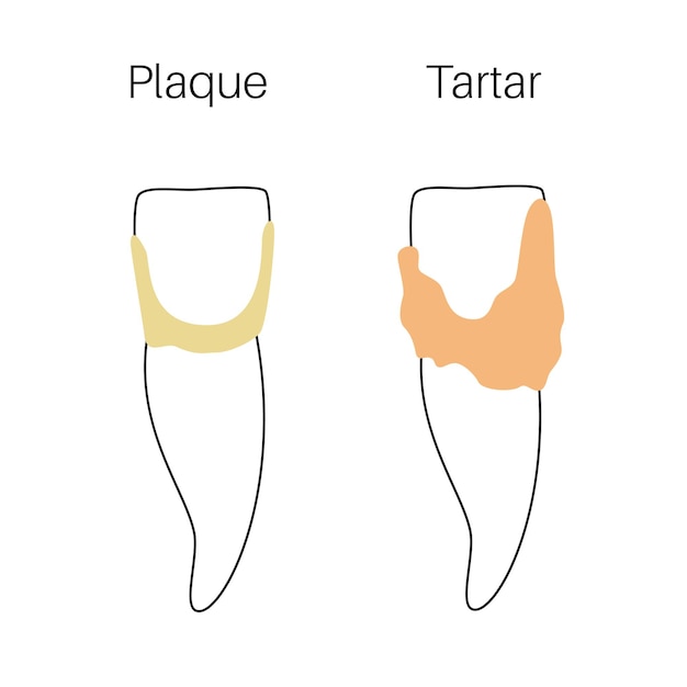 Ilustração em vetor isolada dos estágios de placa dentária. infografia de anatomia do dente. banner médico