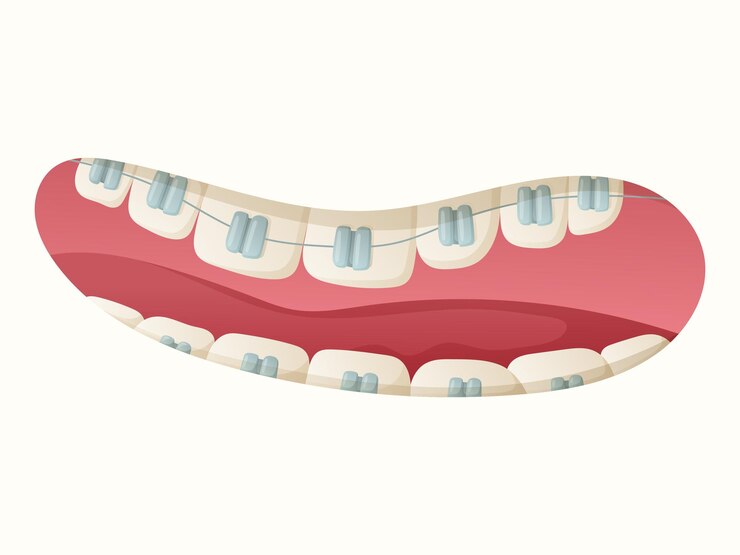Vetor ilustração isolada dos desenhos animados de boca aberta com dentes e aparelho dentário