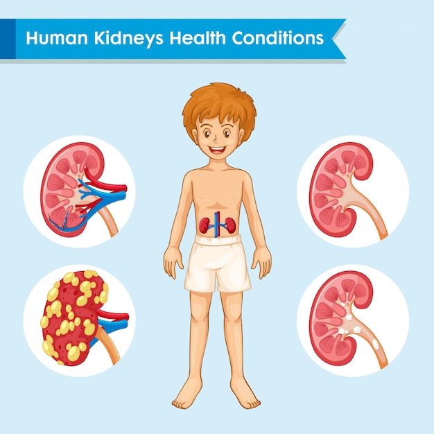 Ilustração médica científica da doença renal