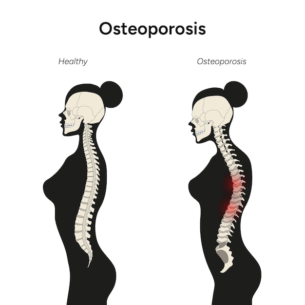 Vetor ilustração médica de osteoporose em vetor