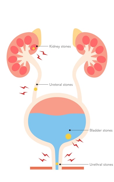 Vetor ilustração médica de pedras do trato urinário pedras nos rins pedras no ureter pedras na bexiga pedras na uretra