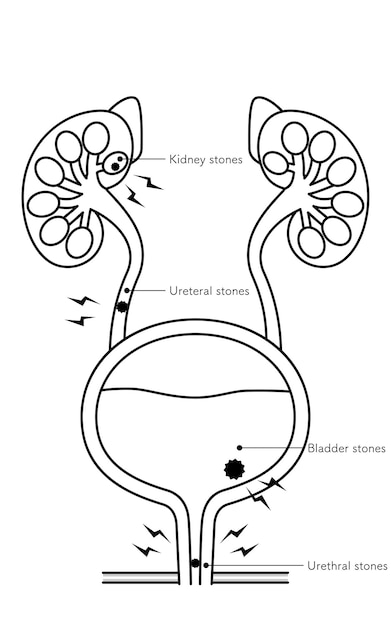 Vetor ilustração médica de pedras do trato urinário pedras nos rins pedras no ureter pedras na bexiga pedras na uretra