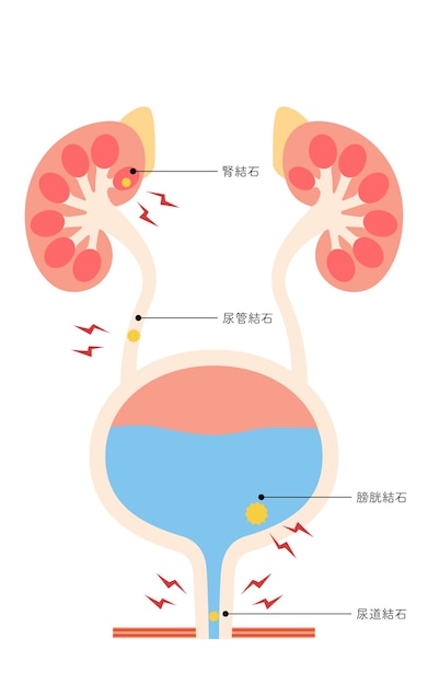 Vetor ilustração médica de pedras do trato urinário pedras nos rins pedras no ureter pedras na bexiga pedras na uretra