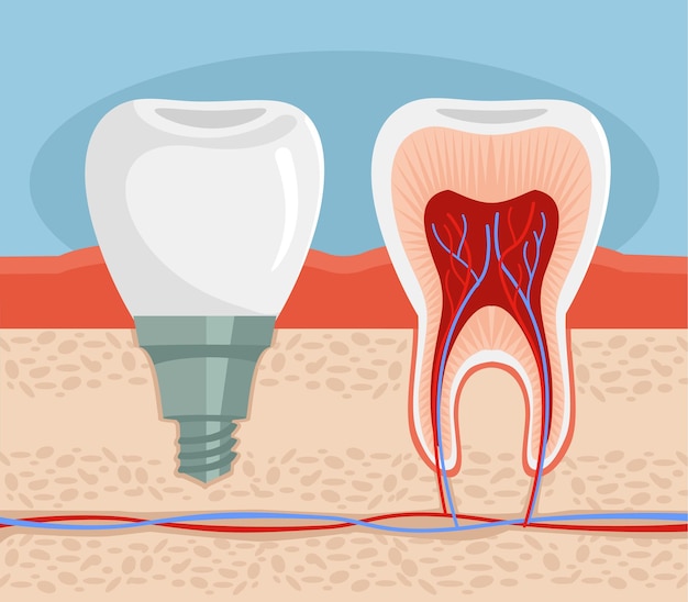 Ilustração plana de implante dentário